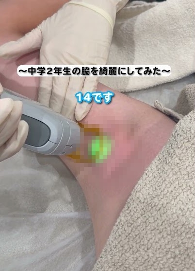 【動画】中学２年生ちゃん、ワキ毛を剃られる動画が39万再生されてしまう…